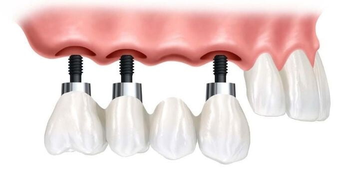 12 часто виникаючих питань про імплантацію зубів