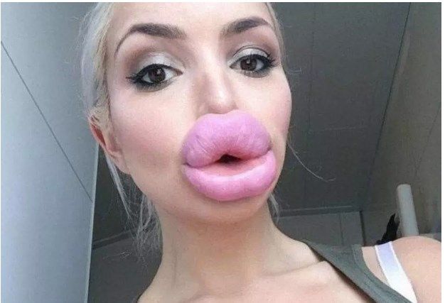 10 раз, коли хтось зробив собі “красиві губи”, хоча більше схоже на діагноз